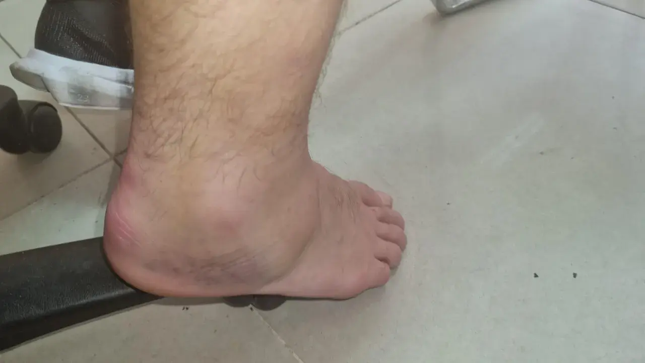 En fot med blåmärken runt ankeln, svullen och röd. Det ser ut som att personen har försökt springa med stukad fot.
