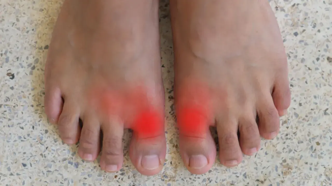Två fötter med röda områden vid stortålederna, som indikerar smärta. Många delar sina hallux rigidus erfarenheter online.