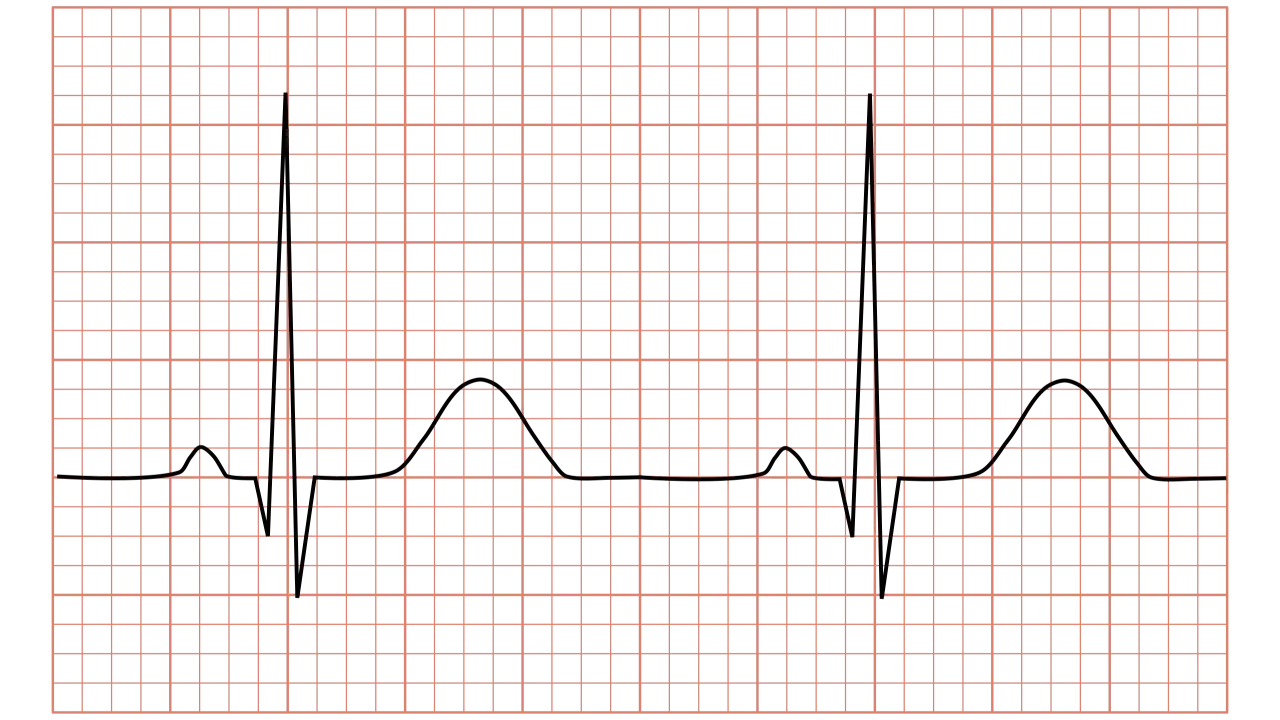 EKG-kurva som visar hjärtats rytm. Varierande avstånd mellan hjärtslagen kan indikera förändringar i HRV status.
