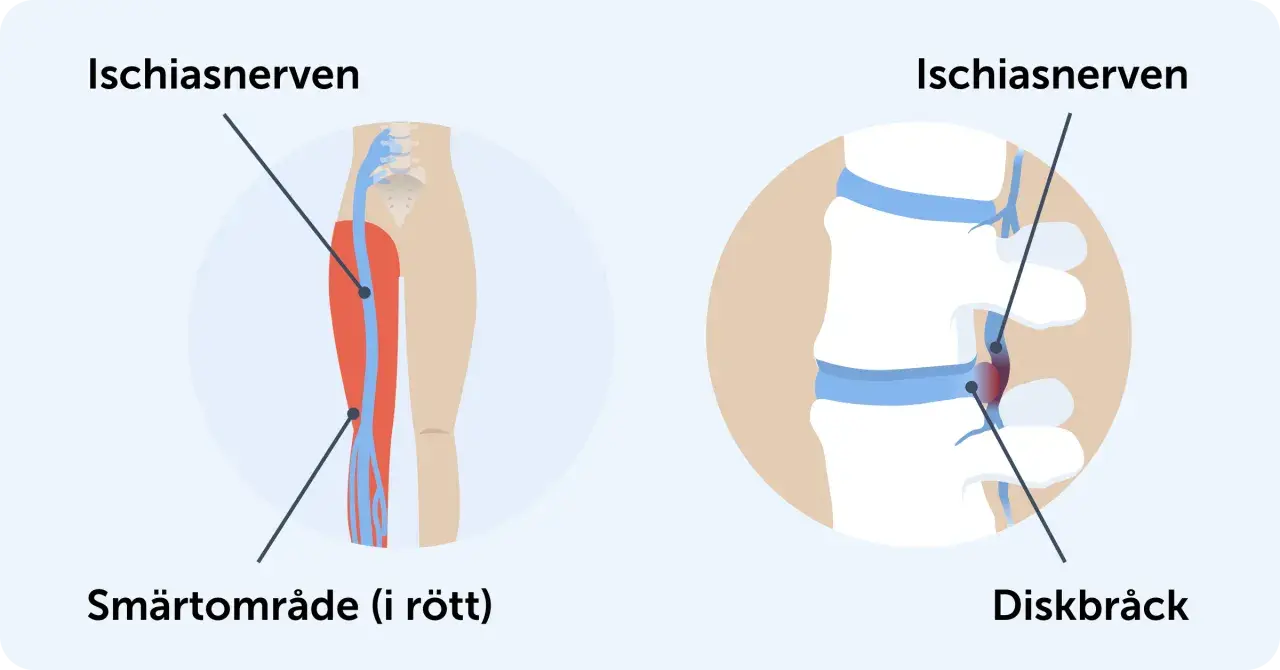 Illustration av ischiasnerven och smärtområde i benet, samt diskbråck som orsakar falsk ischias.