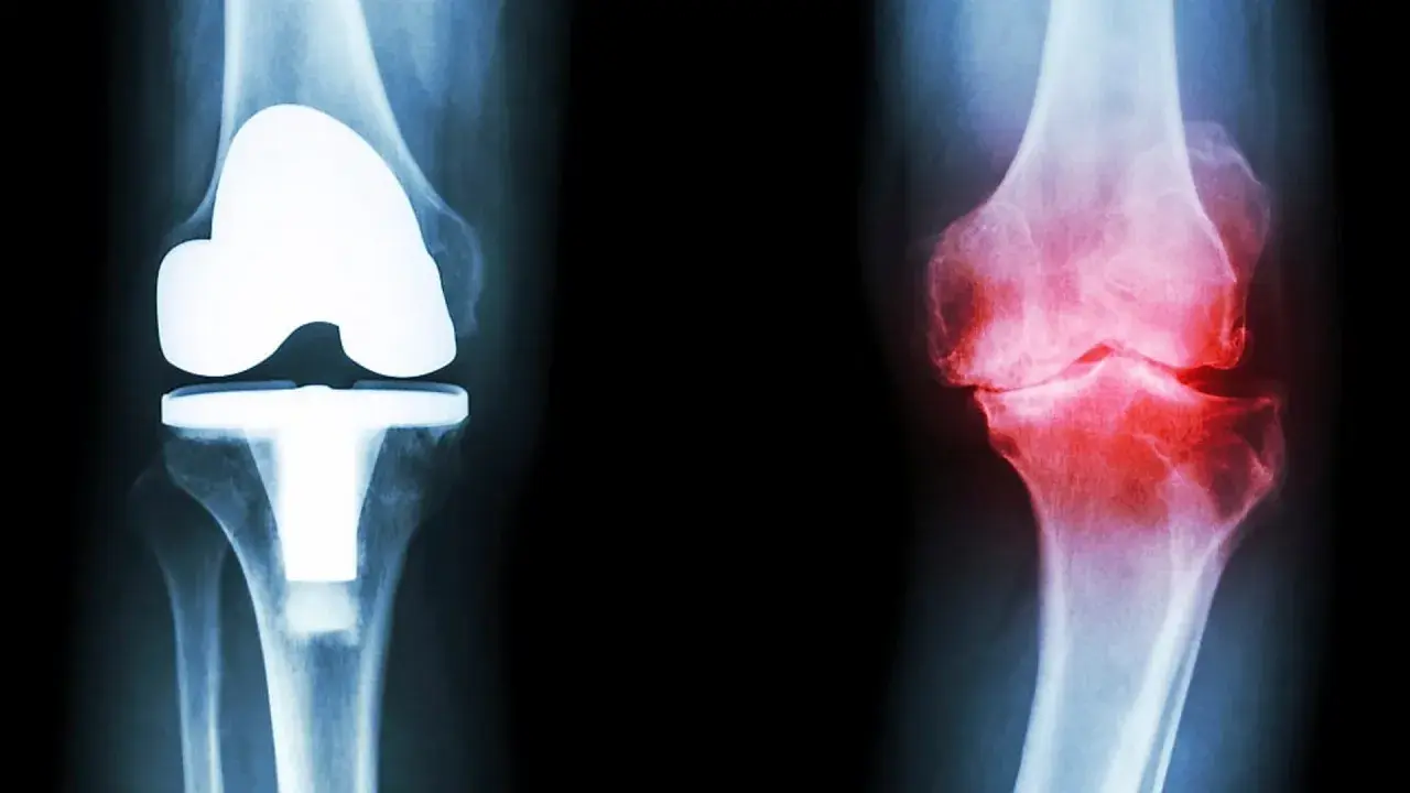 Röntgenbilder av knän: ett med protes, ett med inflammation. Ger rekommendationer efter kortisoninjektion.