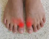 Två fötter med röda områden vid stortålederna, som indikerar smärta. Många delar sina hallux rigidus erfarenheter online.