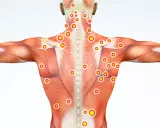 Muskulatur med markerade trapezius triggerpunkter. Röda cirklar med gula prickar visar var smärtan kan sitta.