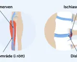 Illustration av ischiasnerven och smärtområde i benet, samt diskbråck som orsakar falsk ischias.