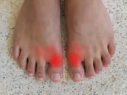 Två fötter med röda områden vid stortålederna, som indikerar smärta. Många delar sina hallux rigidus erfarenheter online.