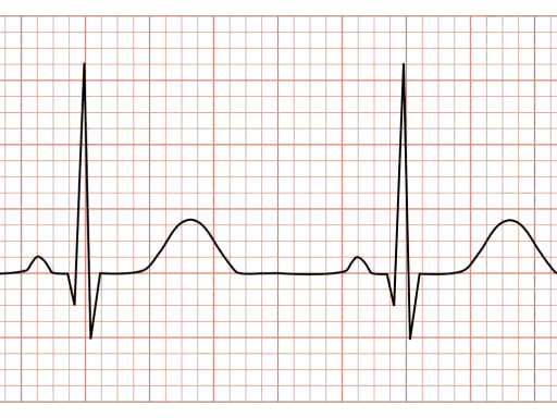 EKG-kurva som visar hjärtats rytm. Varierande avstånd mellan hjärtslagen kan indikera förändringar i HRV status.