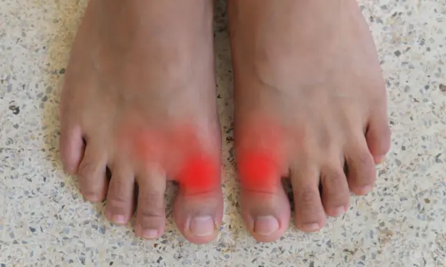 Två fötter med röda områden vid stortålederna, som indikerar smärta. Många delar sina hallux rigidus erfarenheter online.