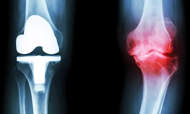 Röntgenbilder av knän: ett med protes, ett med inflammation. Ger rekommendationer efter kortisoninjektion.
