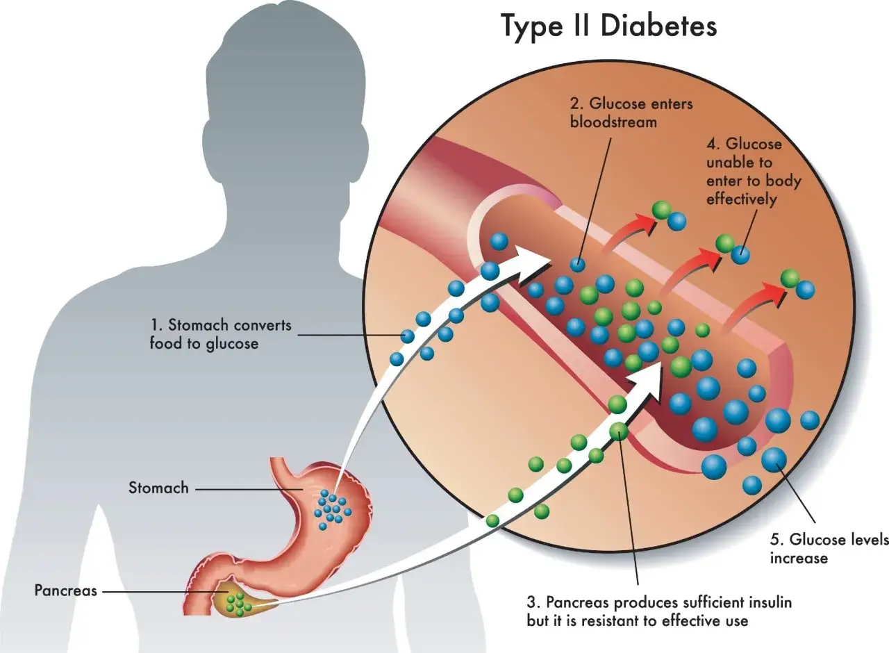 Illustration visar hur socker p&aring;verkar kroppen vid typ 2-diabetes: mat blir glukos, som hamnar i blodet. Bukspottk&ouml;rteln producerar insulin, men kroppen kan inte anv&auml;nda det effektivt.