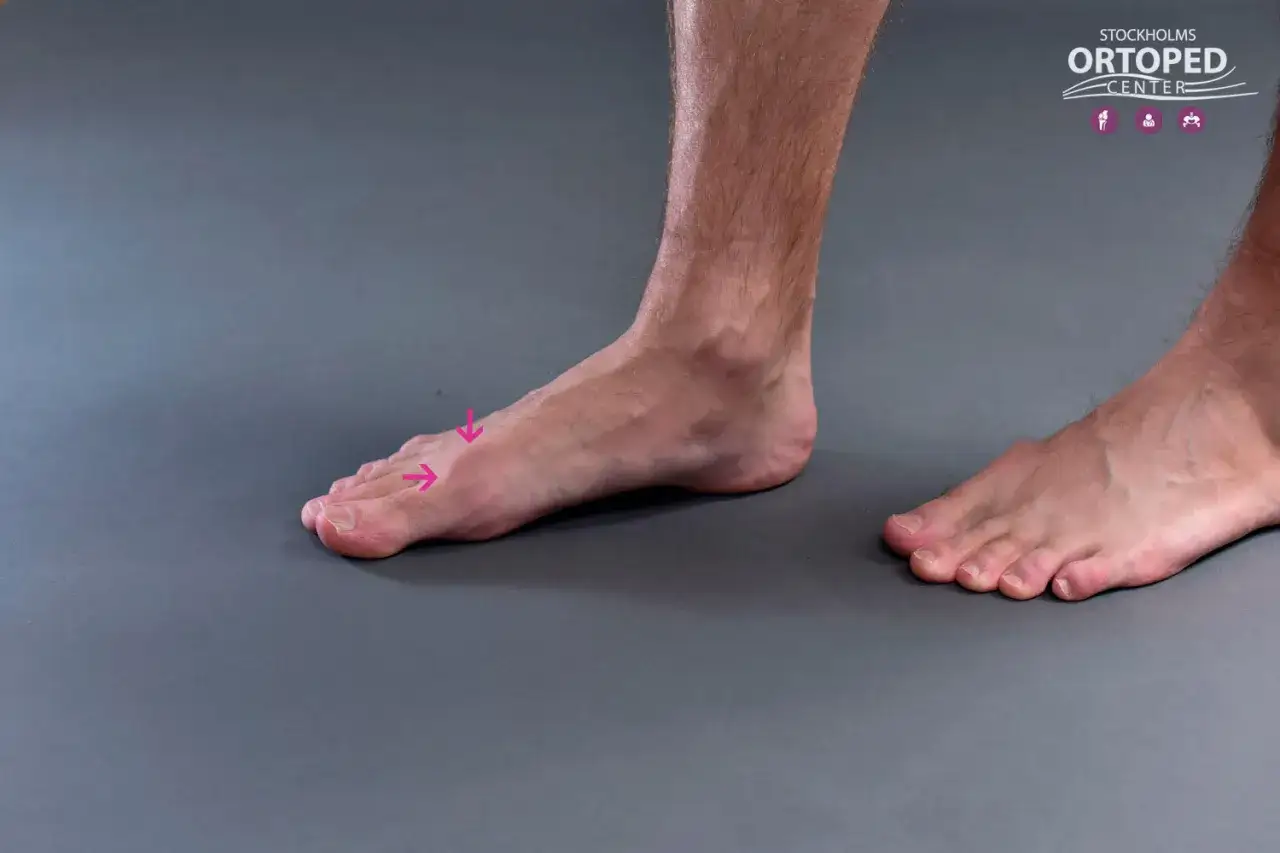 Foten visar tecken på hallux rigidus erfarenheter, med en stel stortåled markerad med rosa pilar.