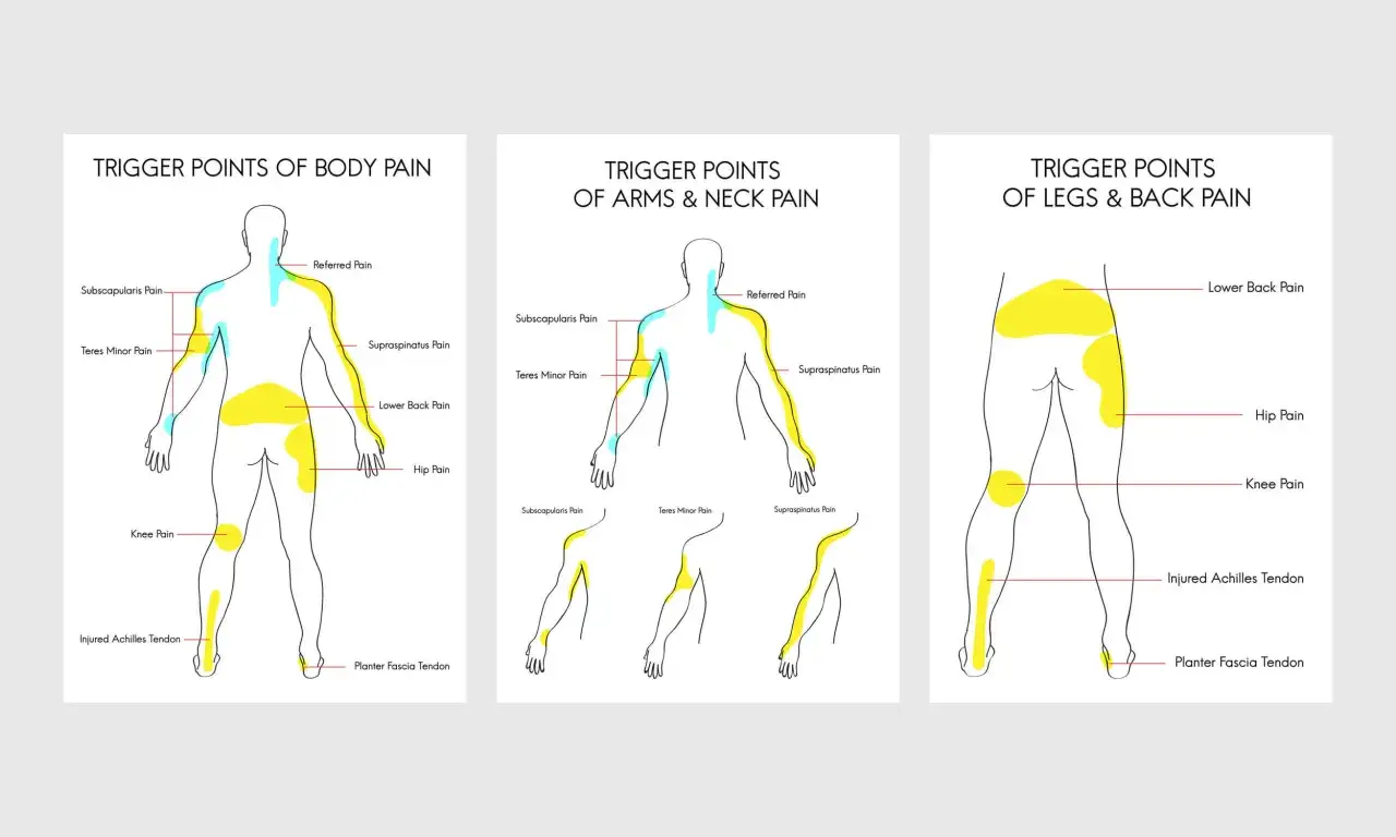Illustrationer visar sm&auml;rtpunkter i kroppen, inklusive trapezius triggerpunkter, som kan orsaka sm&auml;rta i nacke, rygg och armar.