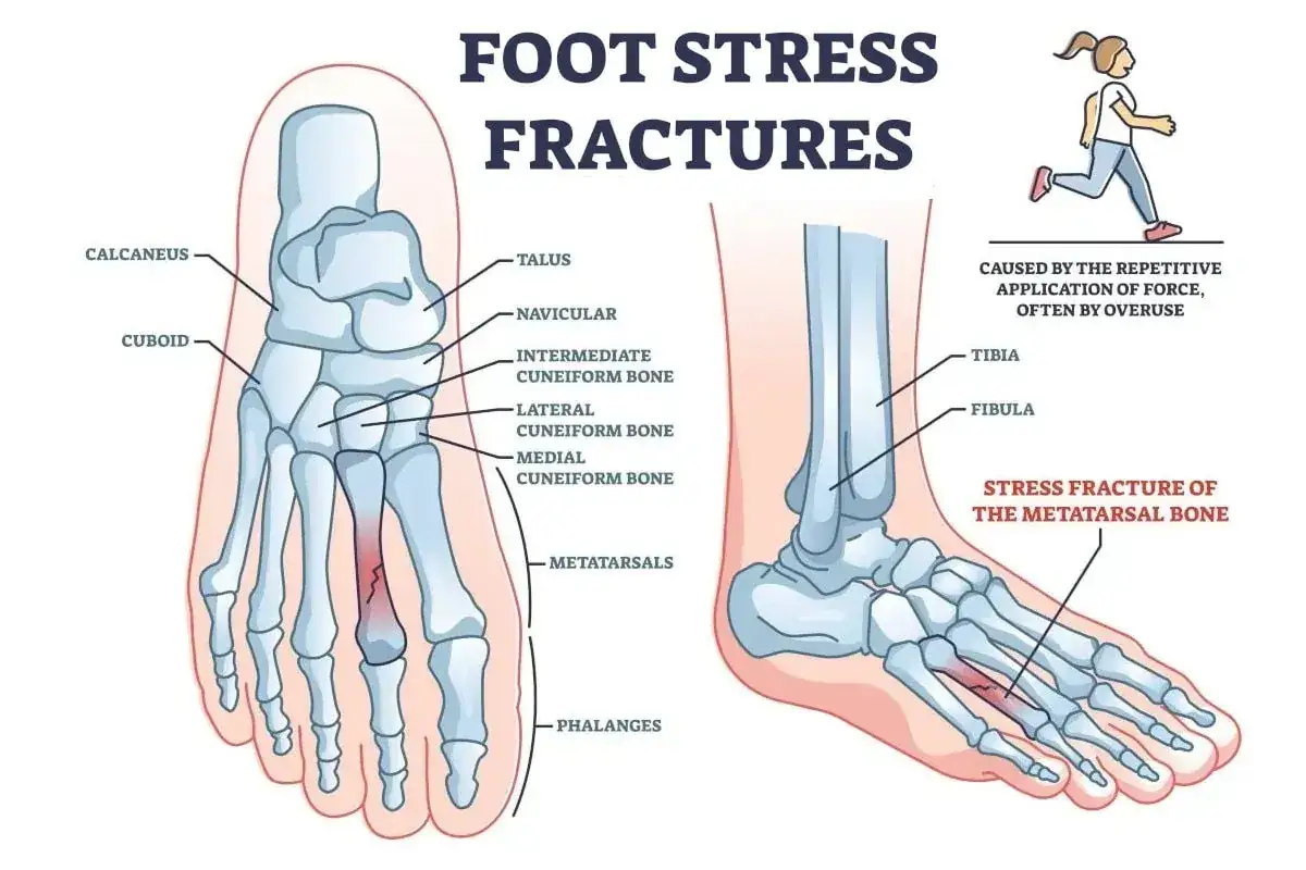 Illustration visar fotens skelett med en stressfraktur i en metatarsal. Orsakas av upprepad belastning.